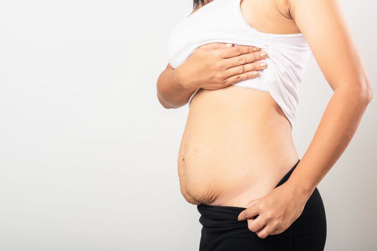 Bauchdeckenstraffung