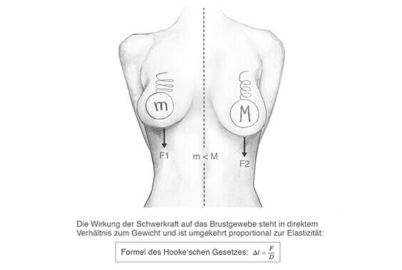 Skizze eines weiblichen Oberkörpers, die die Wirkung der Schwerkraft auf das Brustgewebe zeigt. Links ist eine kleinere Brust mit weniger Gewicht dargestellt (m), rechts eine größere Brust mit mehr Gewicht (M). Die Pfeile F1 und F2 zeigen die nach unten w