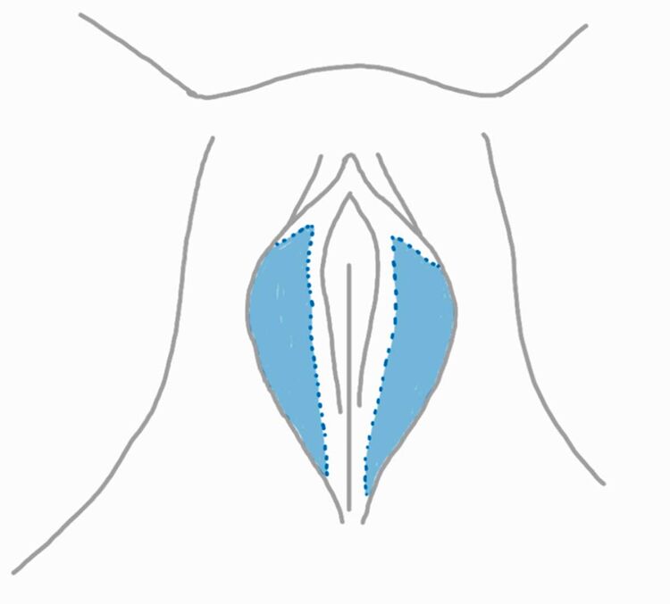 Wedge Resektion